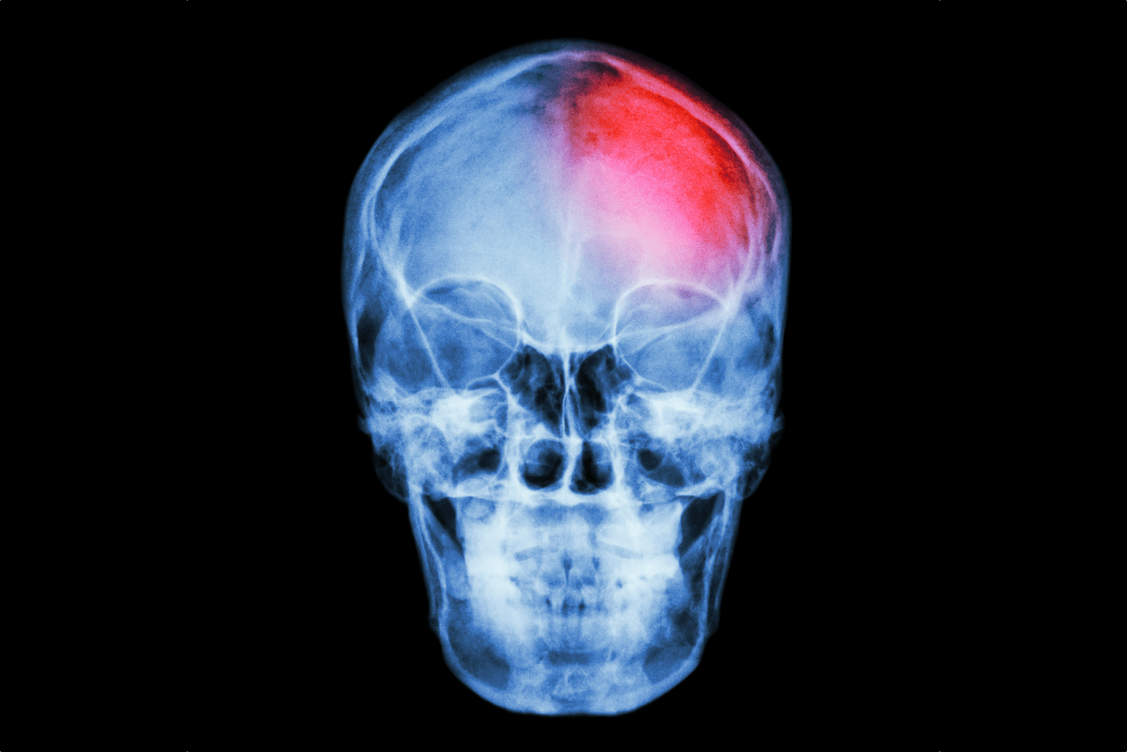 Сотрясение черепа. Рентгеновские снимки черепа. Рентген человеческого черепа.
