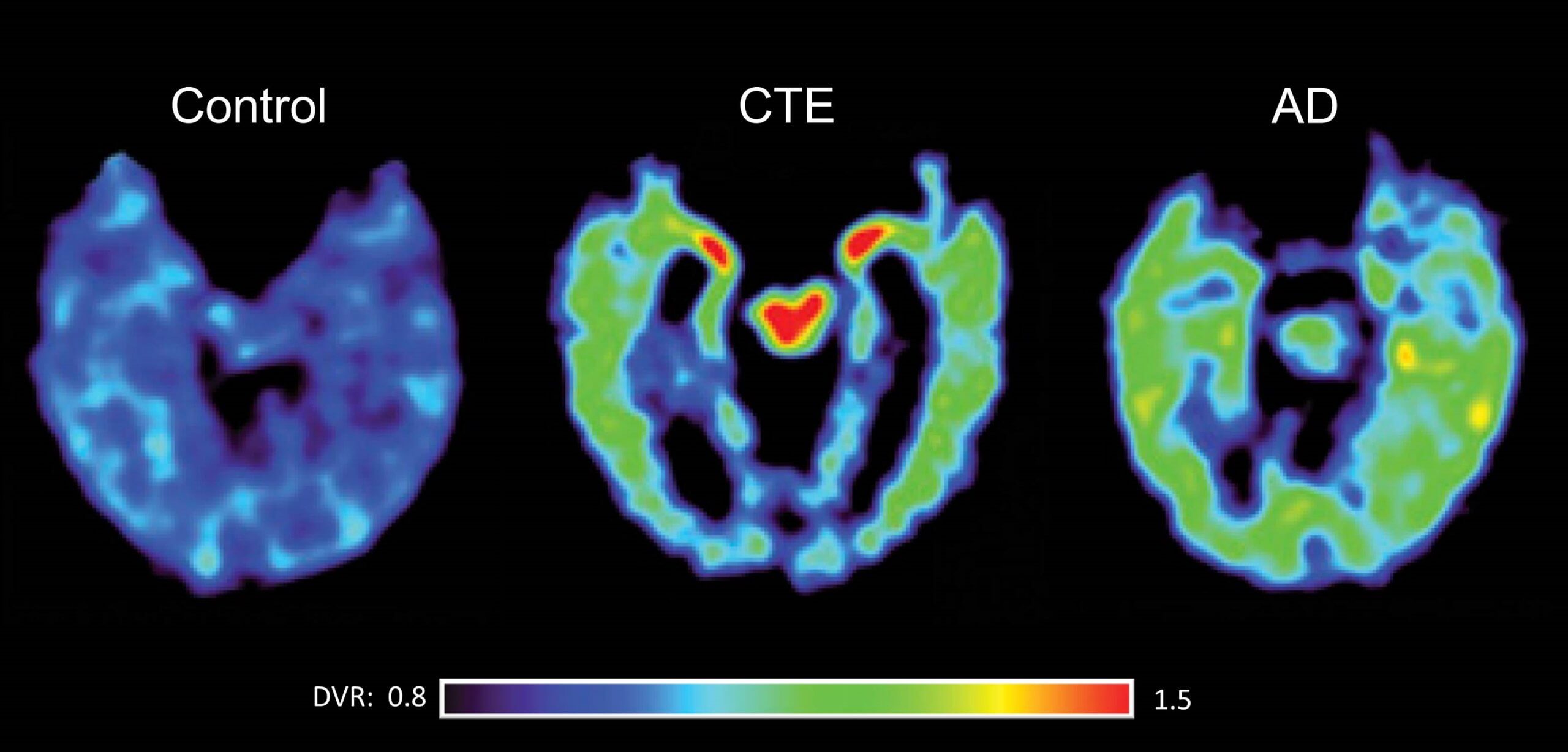 Dementia and CTE: Differences, Similarities and Impace